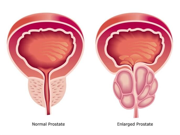 Prostovit normalisiert die Arbeit und Größe der Prostata