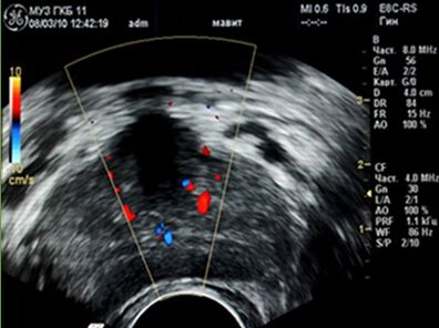 Ultraschall zeigte Entzündungsherde in der Prostata