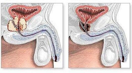 Vor und nach der Behandlung chronischer chirurgischer Prostatitis