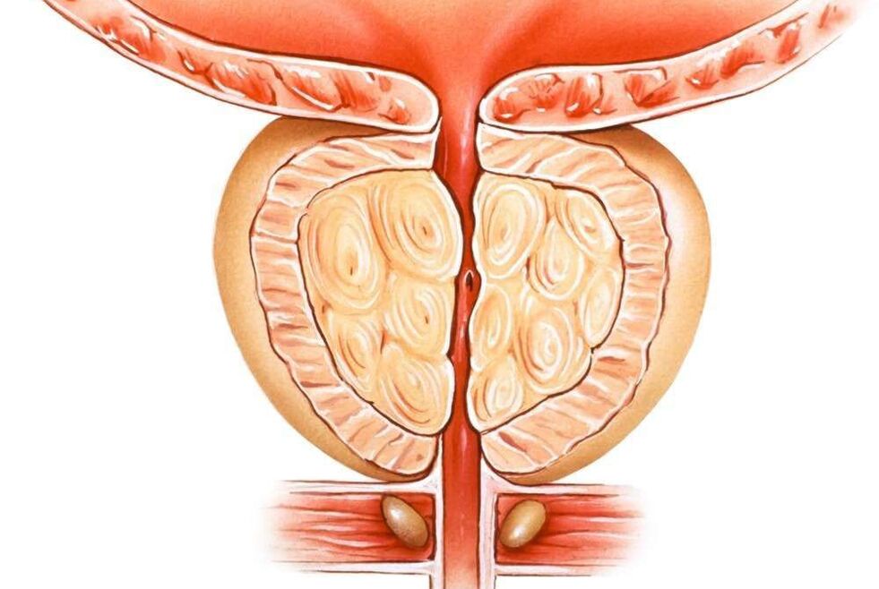 Stauungsprostatitis